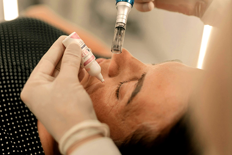 best microneedling in brighton hove best microneedling in brighton hove